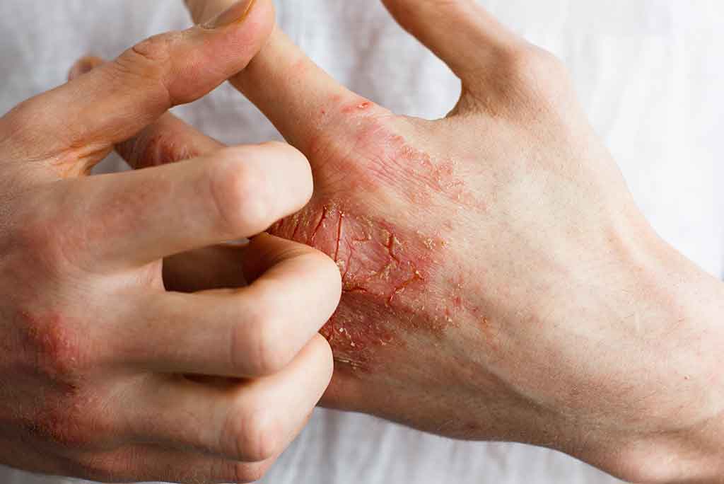 estas son las enfermedades de la piel mas comúnes del país