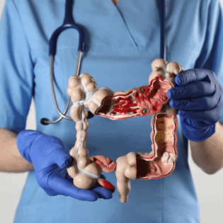 ¿Molestias abdominales frecuentes? Atiéndete, podrían ser señales tempranas de cáncer de colon