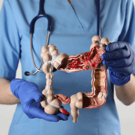 ¿Molestias abdominales frecuentes? Atiéndete, podrían ser señales tempranas de cáncer de colon
