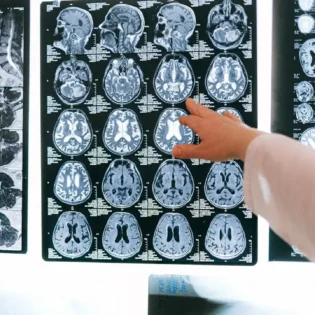 Desarrollan tratamiento para la enfermedad de Huntington