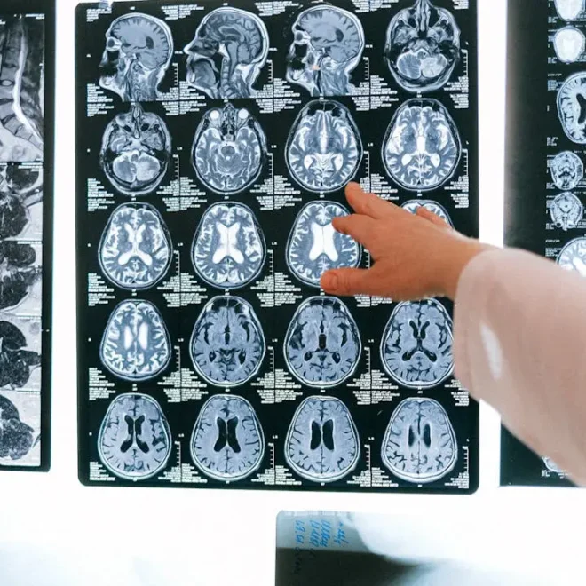 Desarrollan tratamiento para la enfermedad de Huntington